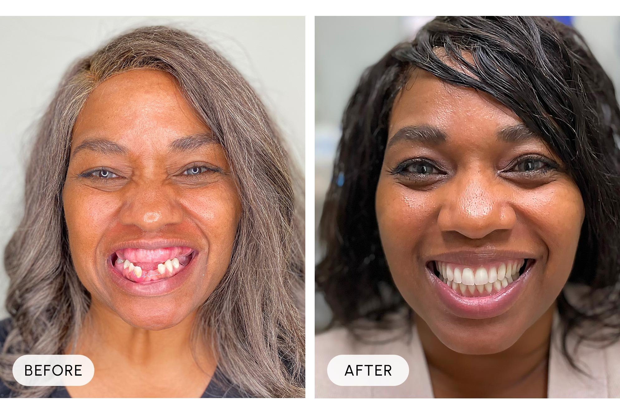 Side-by-side images showing a woman's transformation: on the left, she has missing and crooked teeth; on the right, she has a full set of straight, white teeth, both smiling.