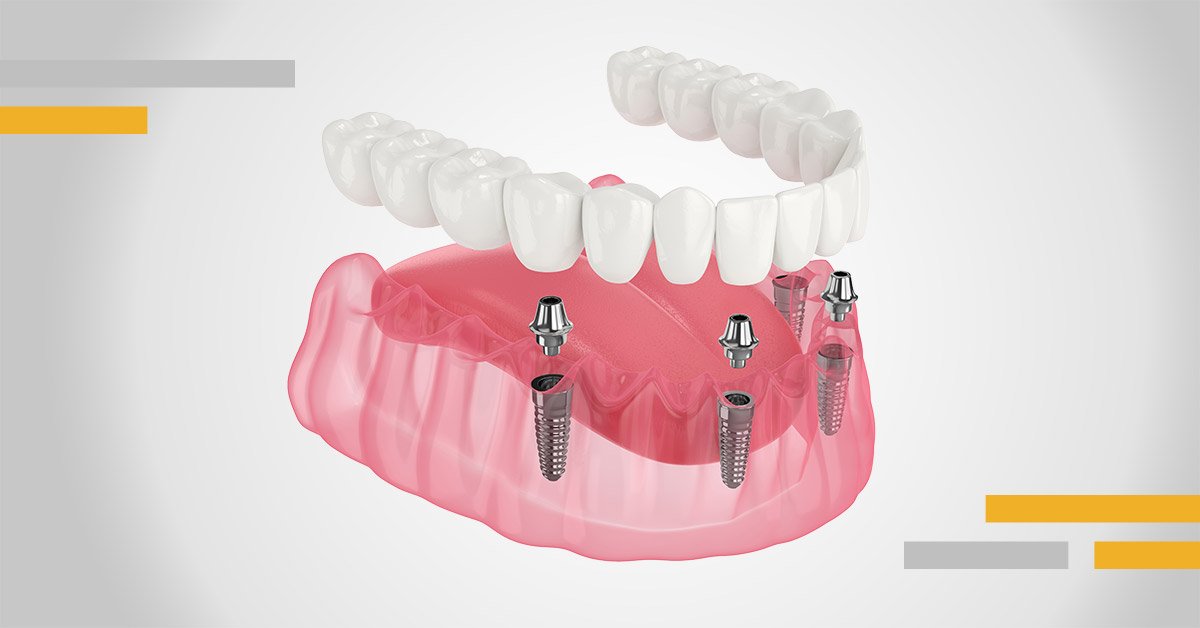 All on 4 dental implant diagram