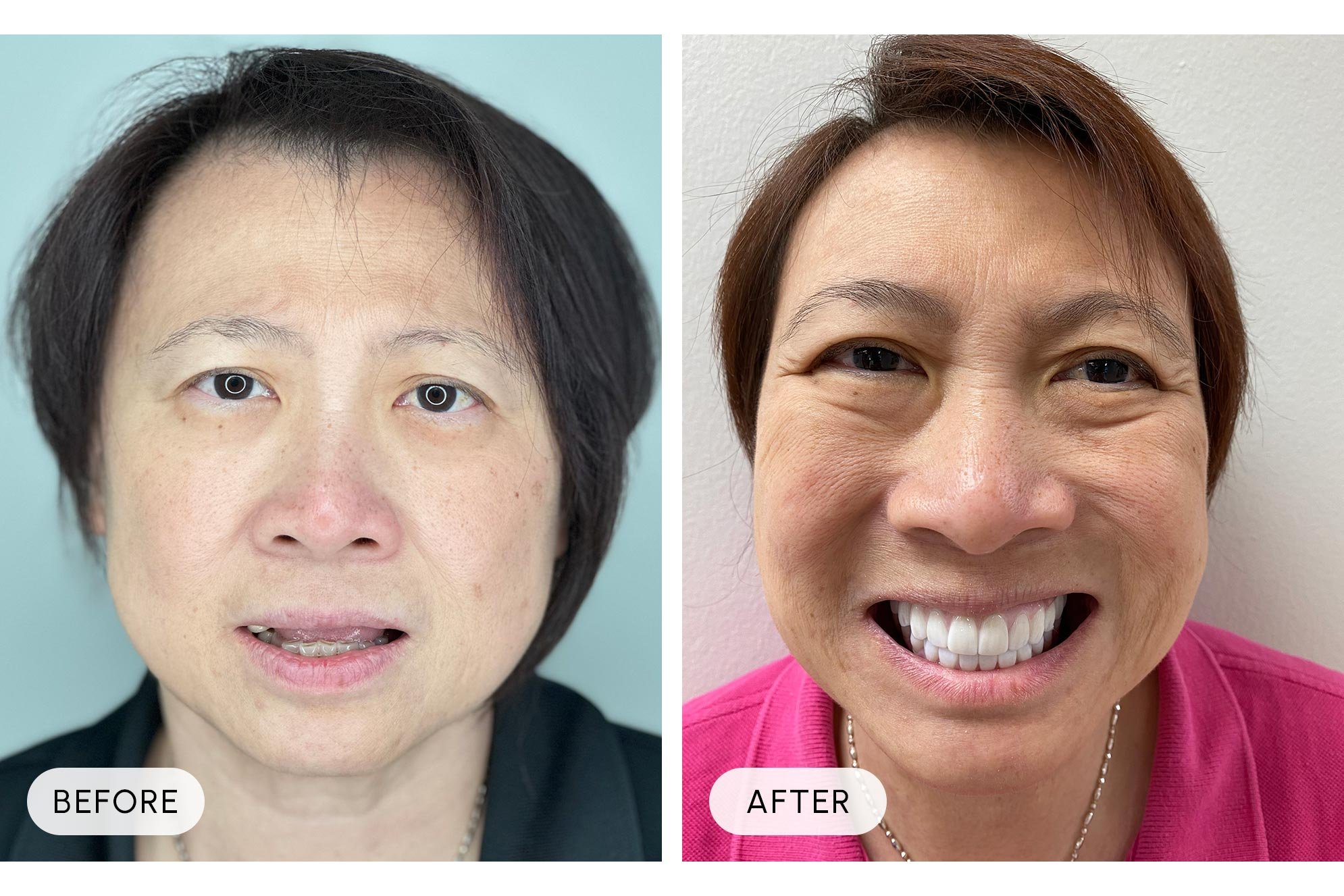Comparison of a woman's face before and after a cosmetic procedure, showing improved skin texture and a brighter smile in the after image.