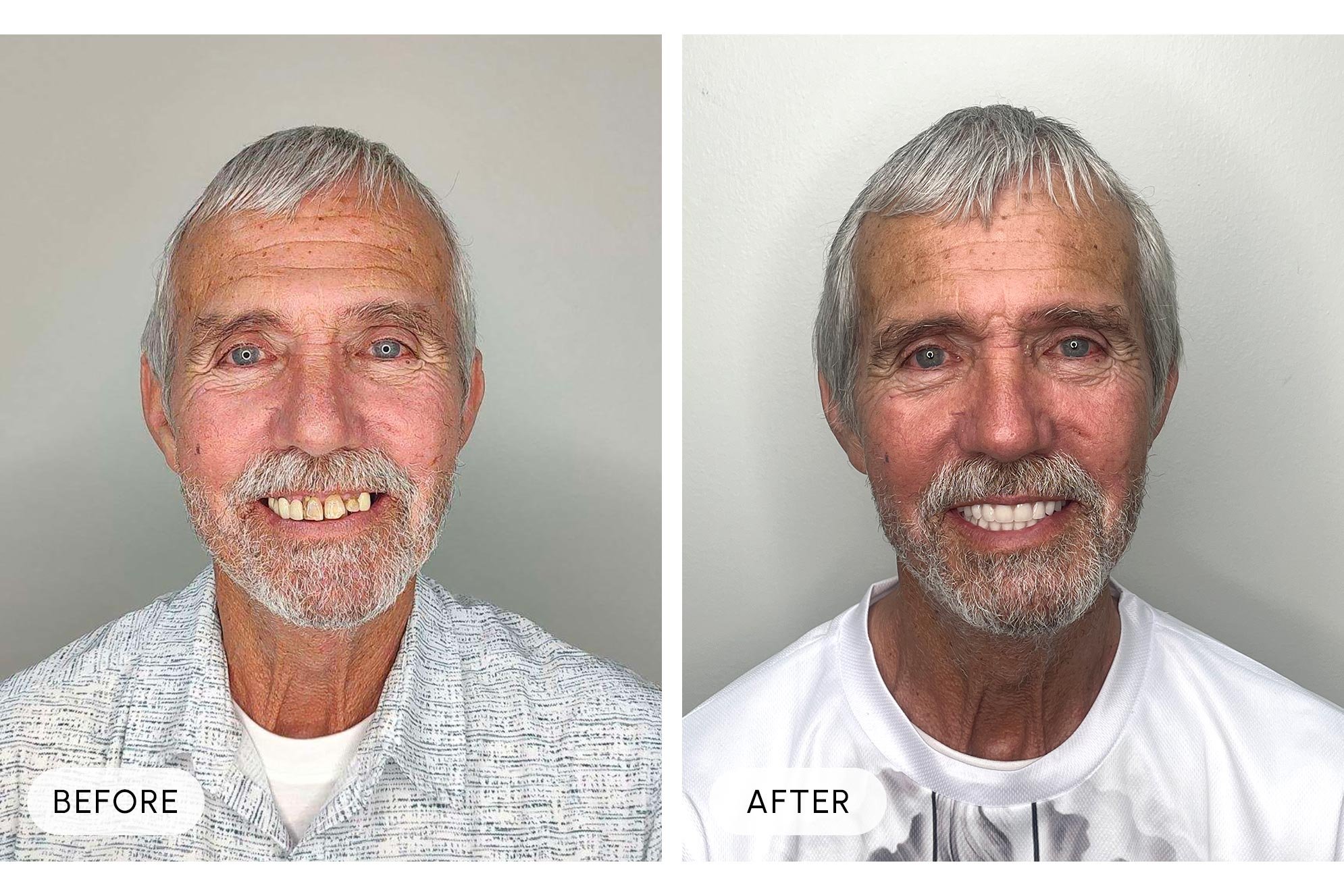 Side-by-side comparison of a smiling elderly man with gray hair and beard, showing before and after images. In the "before" image, he has a small gap between his teeth, and in the "after" image, his teeth appear straighter and more aligned.