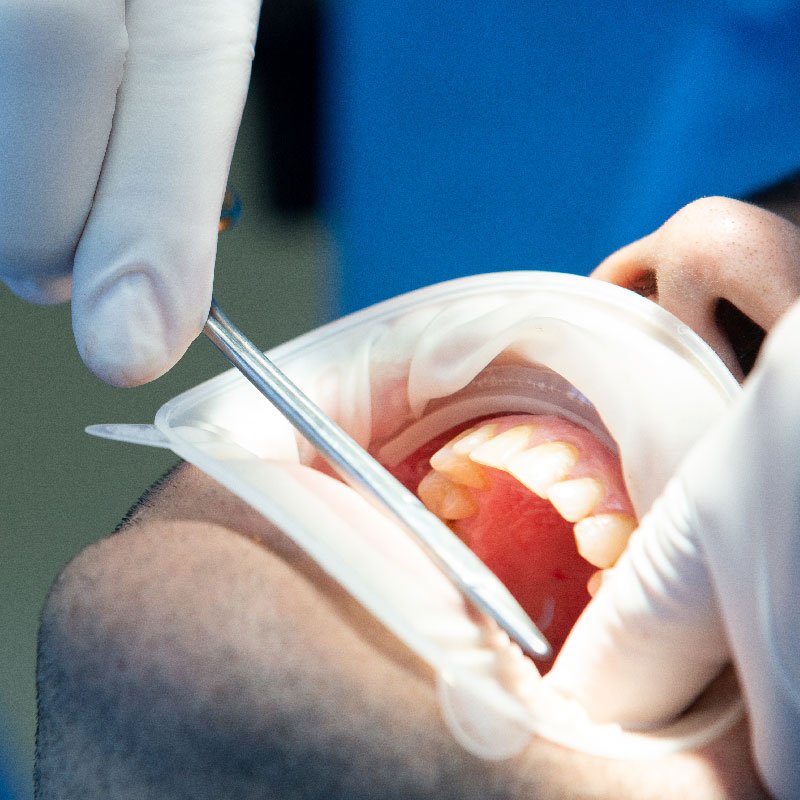 Mouth during oral procedure