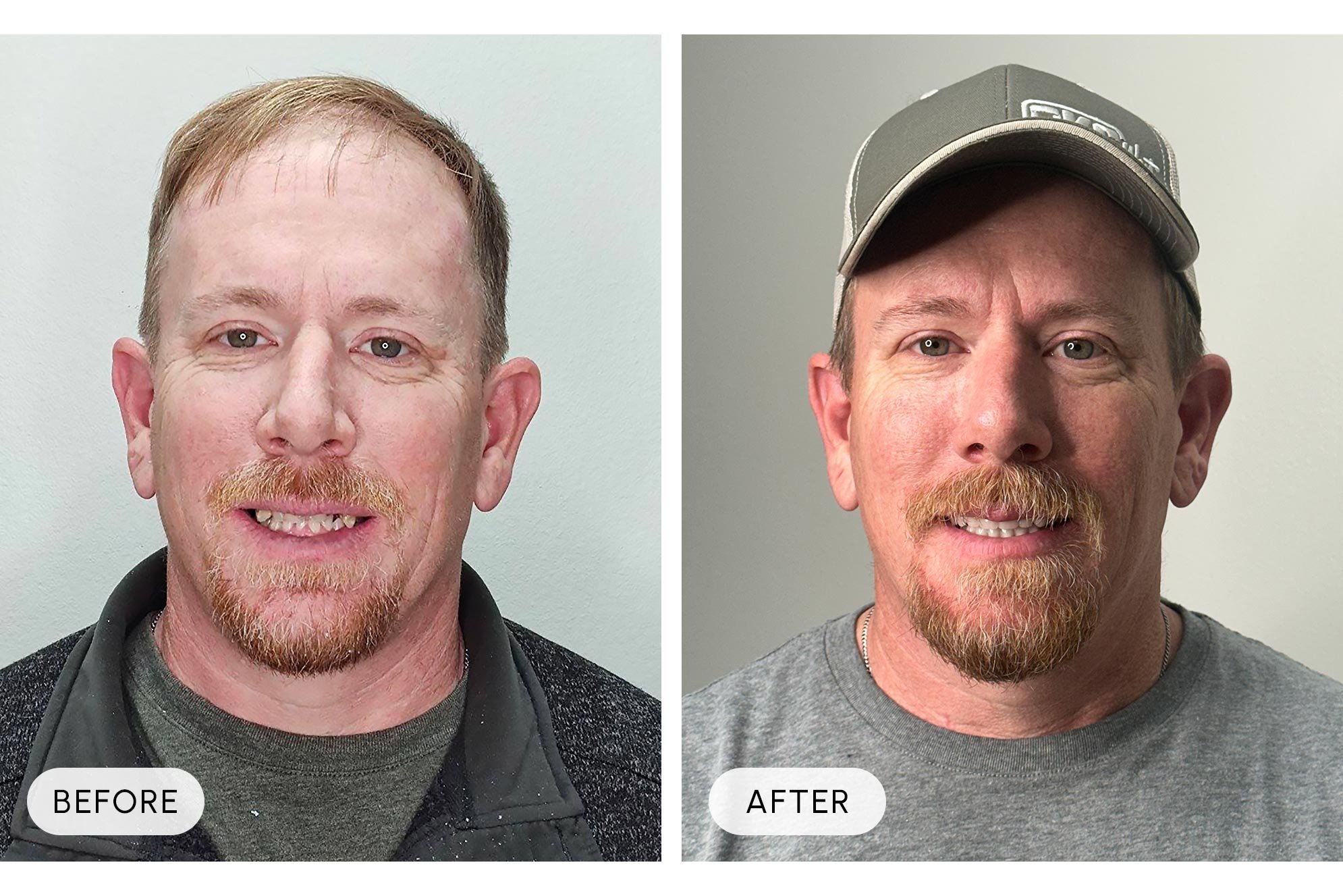 Side-by-side comparison of a man before and after a facial treatment. In the before image, the man has a reddish complexion, facial redness, and slightly uneven skin tone. In the after image, his skin appears clearer, smoother, and more even-toned, a
