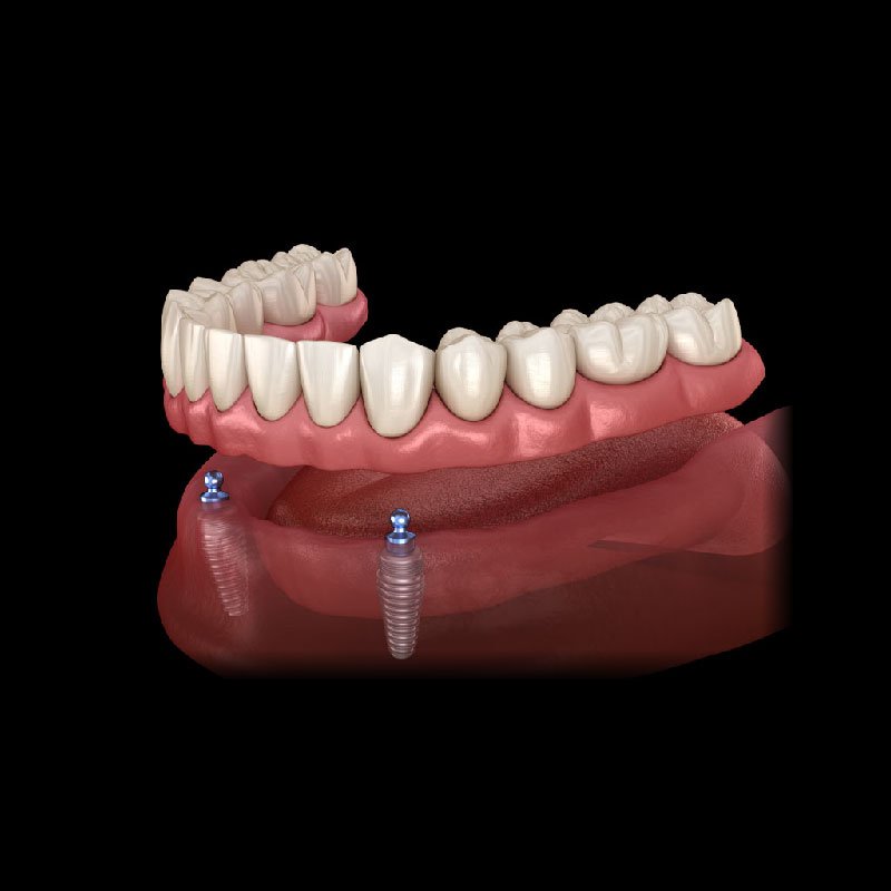 Implant Supported Dentures