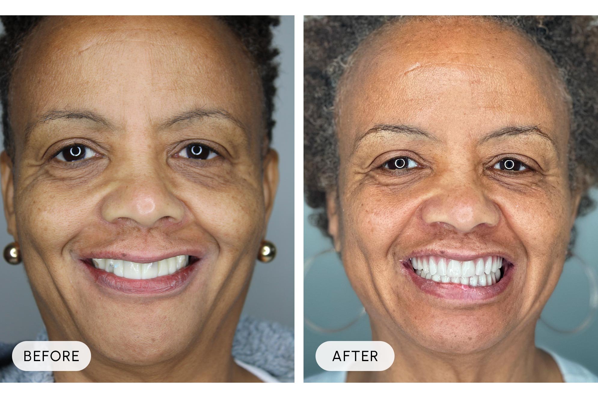 Side-by-side comparison of an older woman's face before and after dental whitening or cosmetic dental procedure, showing a brighter smile in the after photo.