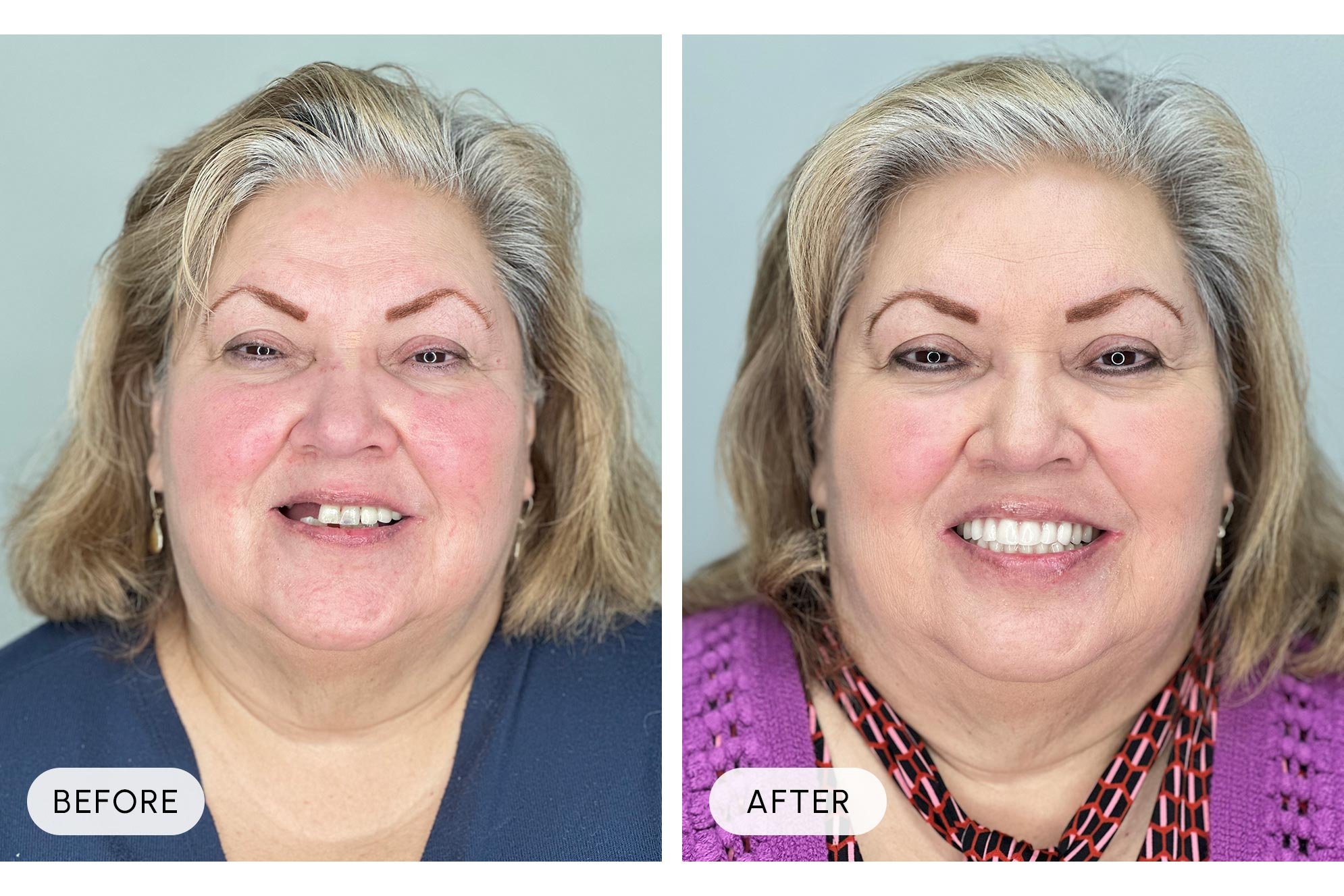 Side-by-side comparison of a middle-aged woman before and after cosmetic treatment. In the before photo, she has uneven skin tone, some wrinkles, and missing teeth. In the after photo, her skin appears smoother, her complexion is even, and she is smi