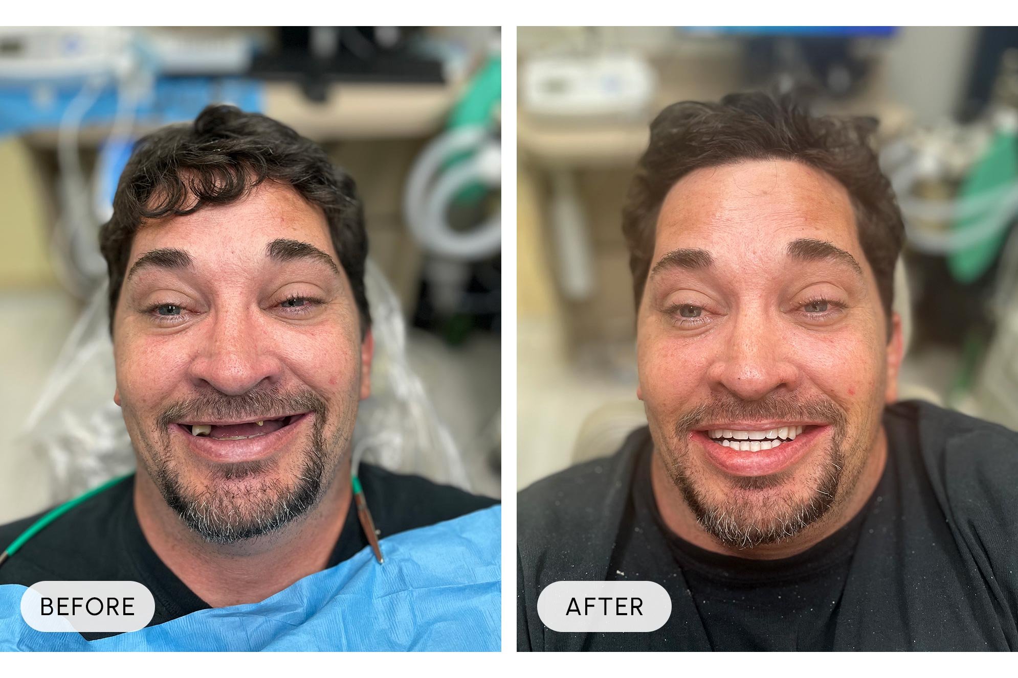 Side-by-side comparison of a man before and after a dental procedure, showing significant dental restoration and improvement in smile.